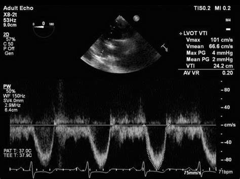echocardiogram displaying high fps