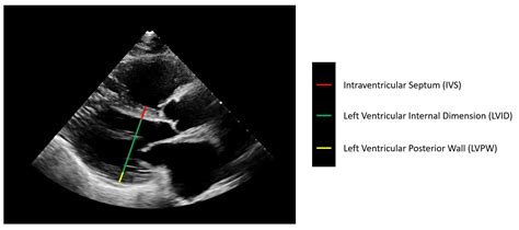 Echocardiogram image of heart