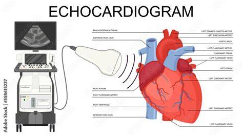 Diagnosis LVH Echocardiogram