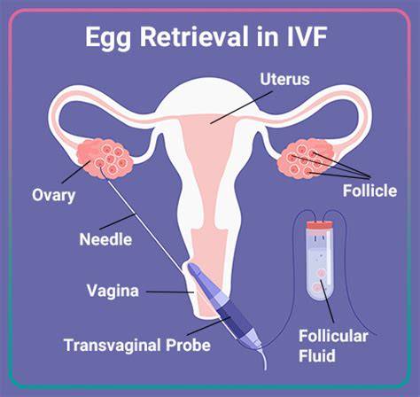Egg Retrieval IVF