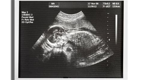explain how ultrasound is used in medical imaging and why it is a preferred method