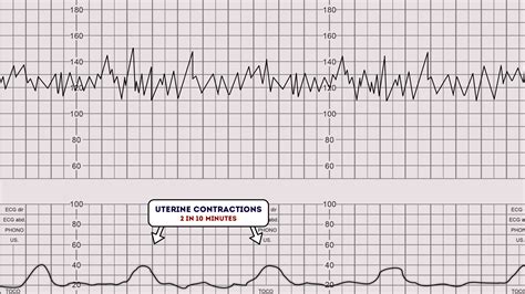 FHR monitoring using CTG