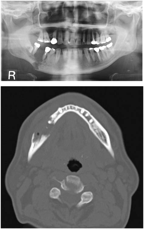 floating bone in jaw