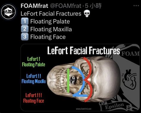 floating maxilla is characteristic feature of