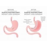 cost of gastric sleeve surgery