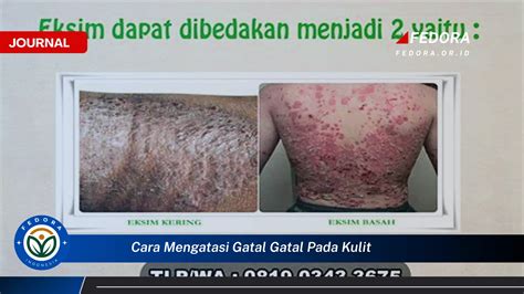 gatal