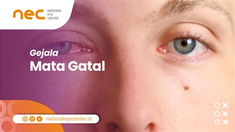 gatal mata