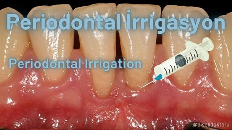gingival irrigation code