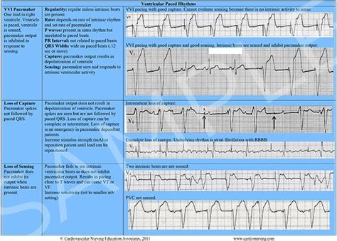 Heart Arrhythmia Chart