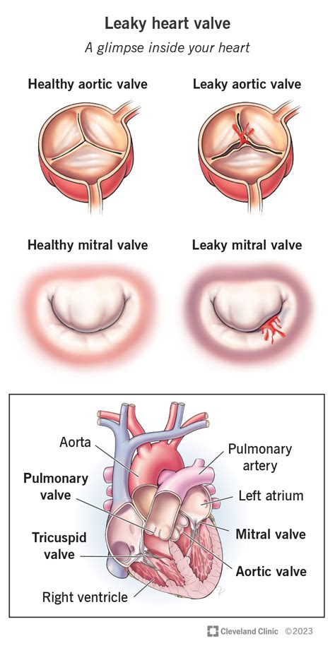 how common is a leaky heart valve