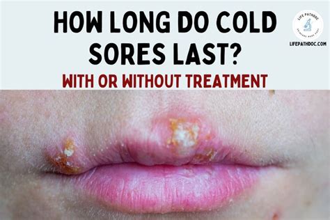 how do you get cold sores randomly