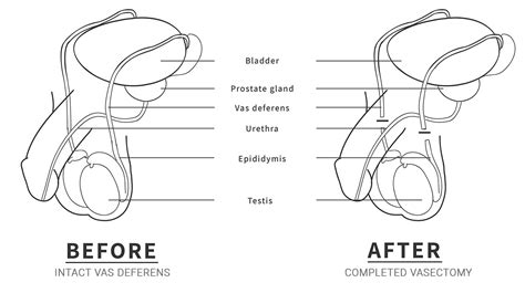 how does a vasectomy work