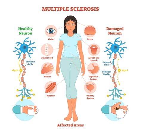 how does exercise affect multiple sclerosis