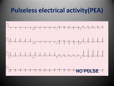 how does pulseless electrical activity work