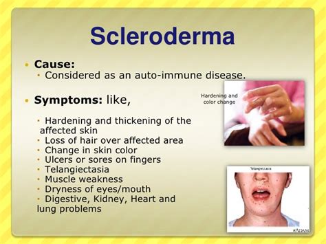 how does scleroderma affect the eyes