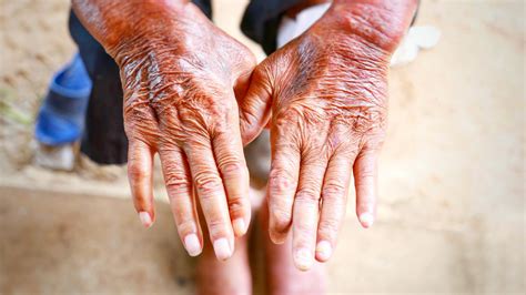 how does scleroderma affect the skin