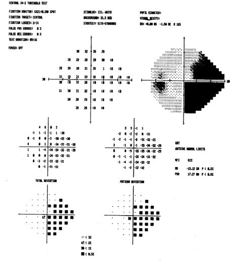 how does visual field test work