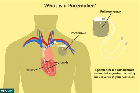 how heavy is a pacemaker