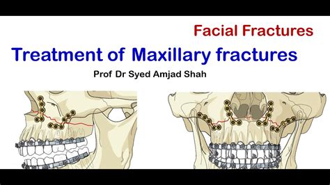 how is a maxillary fracture treated