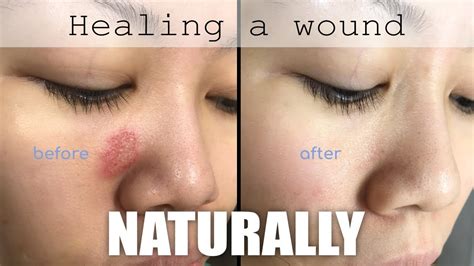 how long does a scrape on face take to heal
