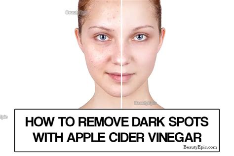 how long does it take apple cider vinegar to remove dark spots