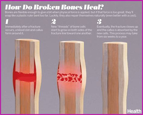 how long does it take for a broken arm to heal in a cast