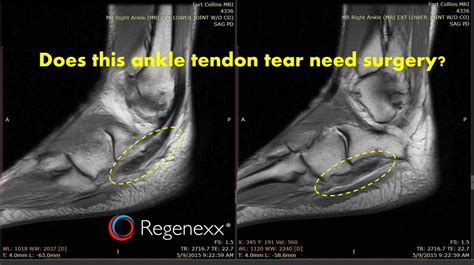 how long does it take for a pulled elbow tendon to heal