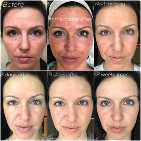 how long does it take for a vampire facial to heal