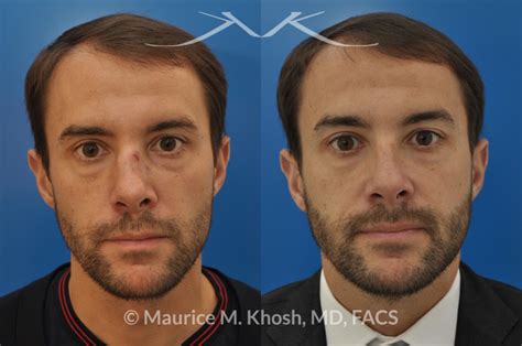 how long does it take to heal a broken cheekbone