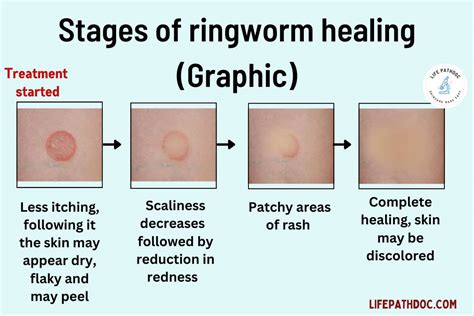 how long does ringworm take to start clearing up
