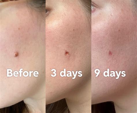 how long will a scrape on my face take to heal
