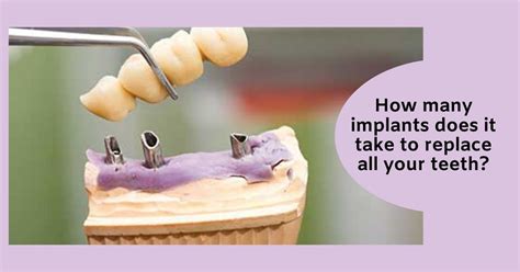 how many implants does it take to replace all your teeth