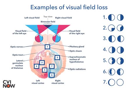 how many visual fields are there