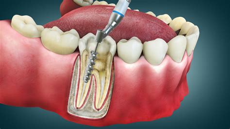 how much does it cost to fix root canal