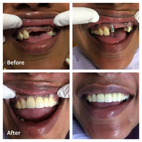 how much to replace all your teeth with implants