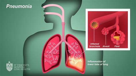 how pneumonia affects lungs