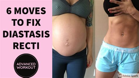how to fix rectus diastasis after pregnancy