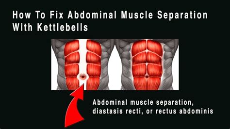 how to fix separated abs
