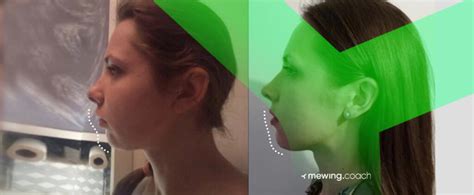 how to get forward maxilla growth