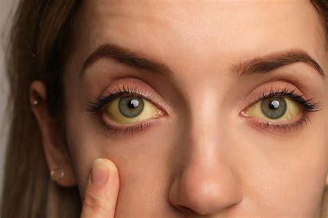 how to get rid of yellow eyes from alcohol