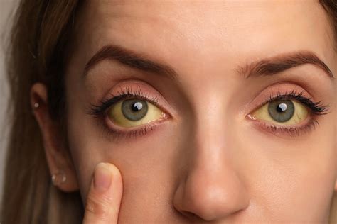 how to get rid of yellow eyes from smoking