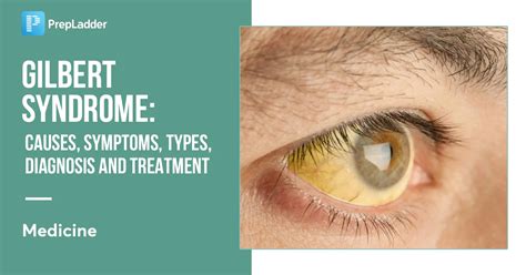 how to get rid of yellow eyes gilbert syndrome