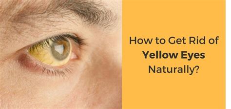 how to get rid of yellow eyes in adults