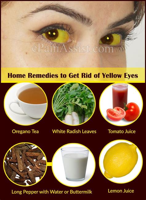 how to get rid of yellow eyes naturally