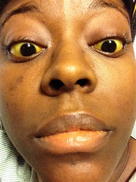how to get rid of yellow eyes sickle cell