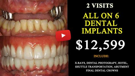 how to get teeth implants for cheap
