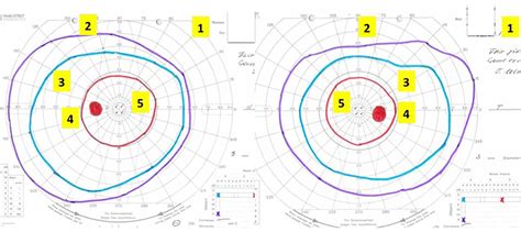how to interpret visual fields