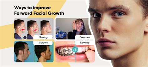 how to make maxilla forward