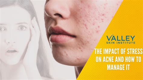 how to reduce stress pimples