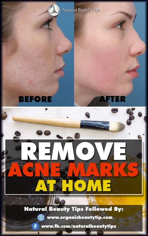 how to remove acne marks faster